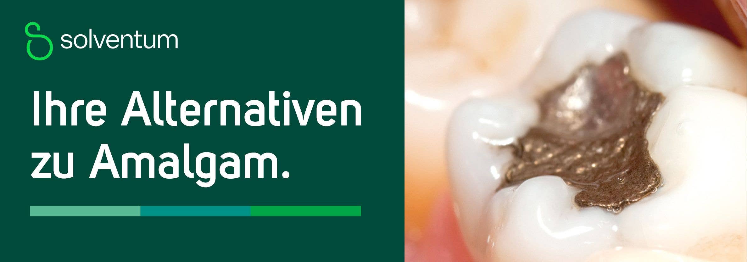 Ihre Alternativen zu Amalgam